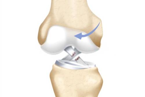 Tratamiento del ligamento cruzado anterior y el ligamento cruzado posterior